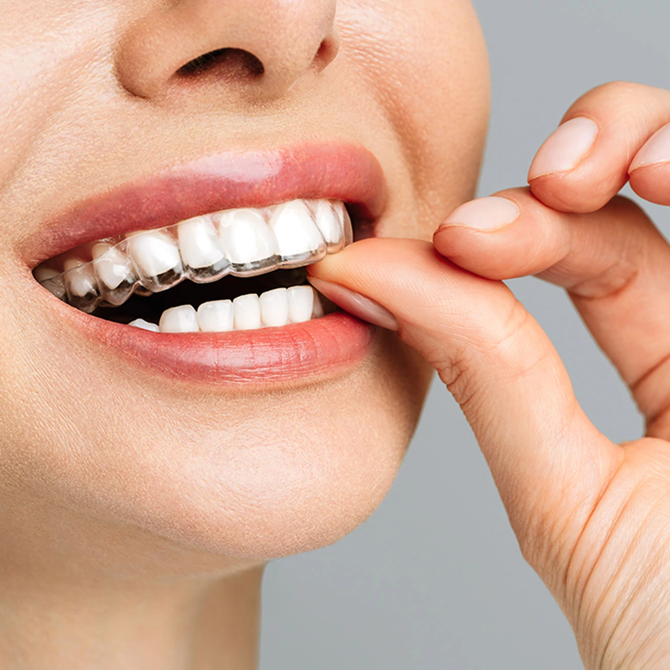 Antes y despúes con los alineadores dentales