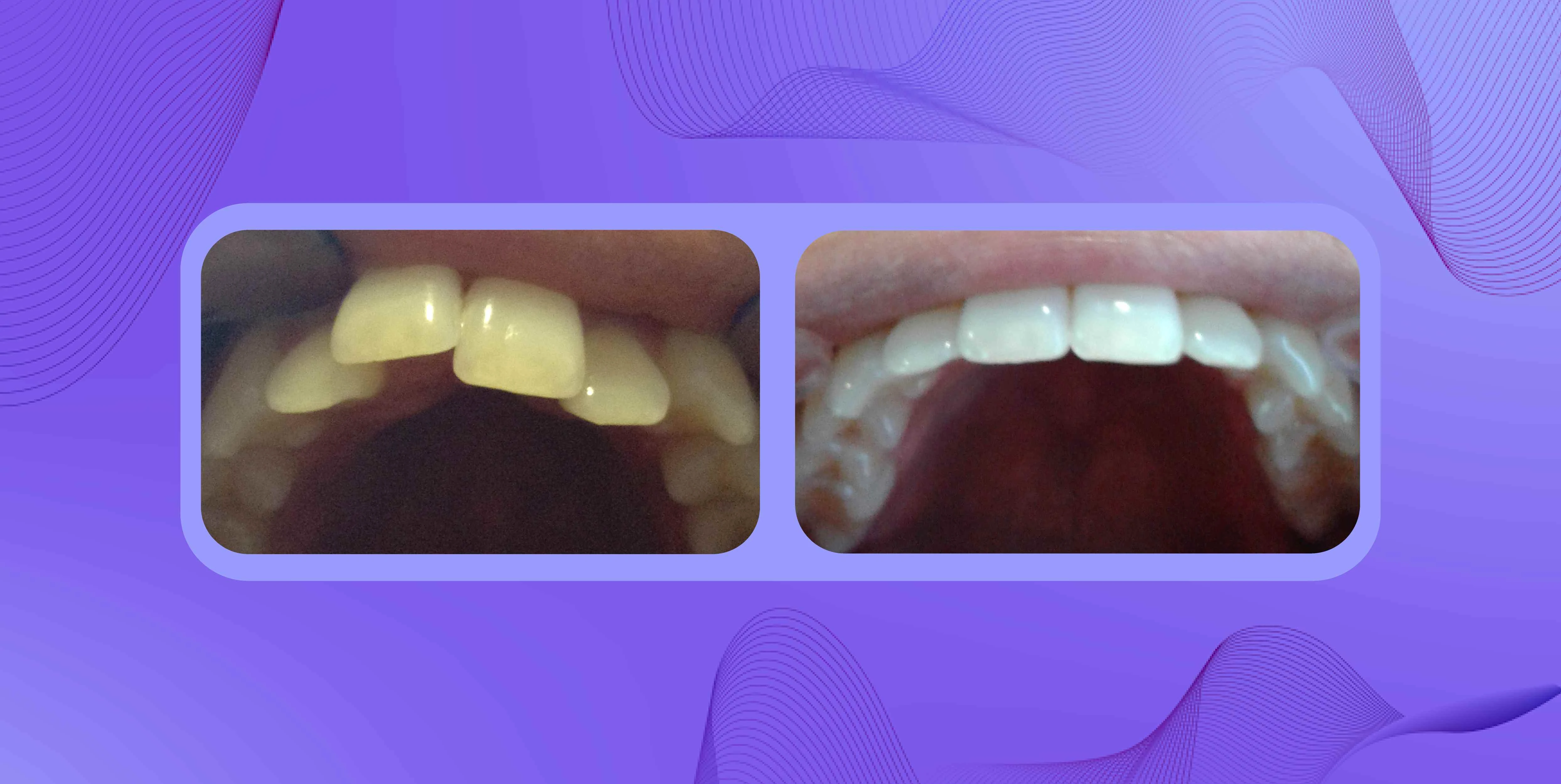 paciente con apiñamiento dental