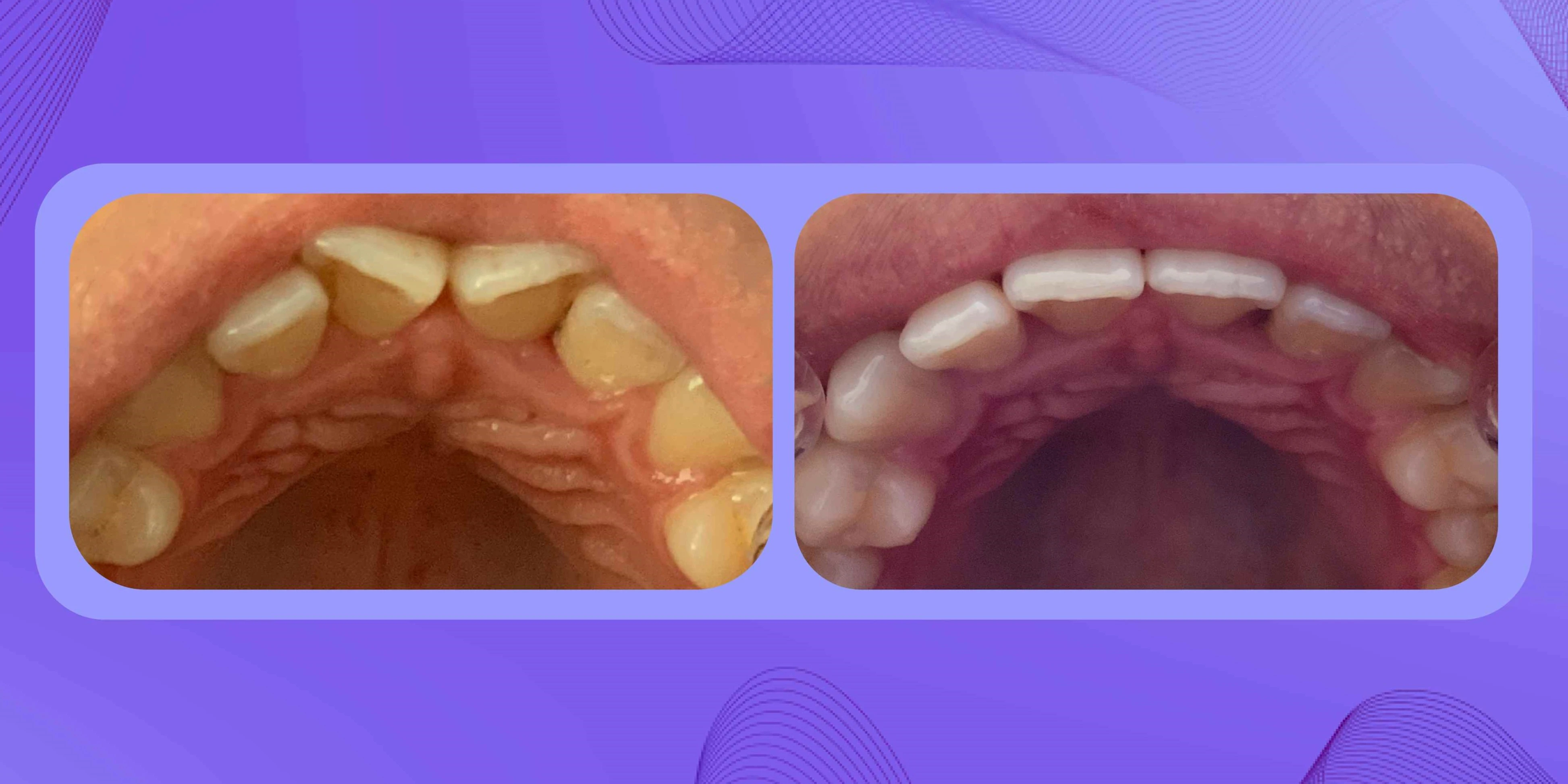 Antes y después de paciente con giroversión