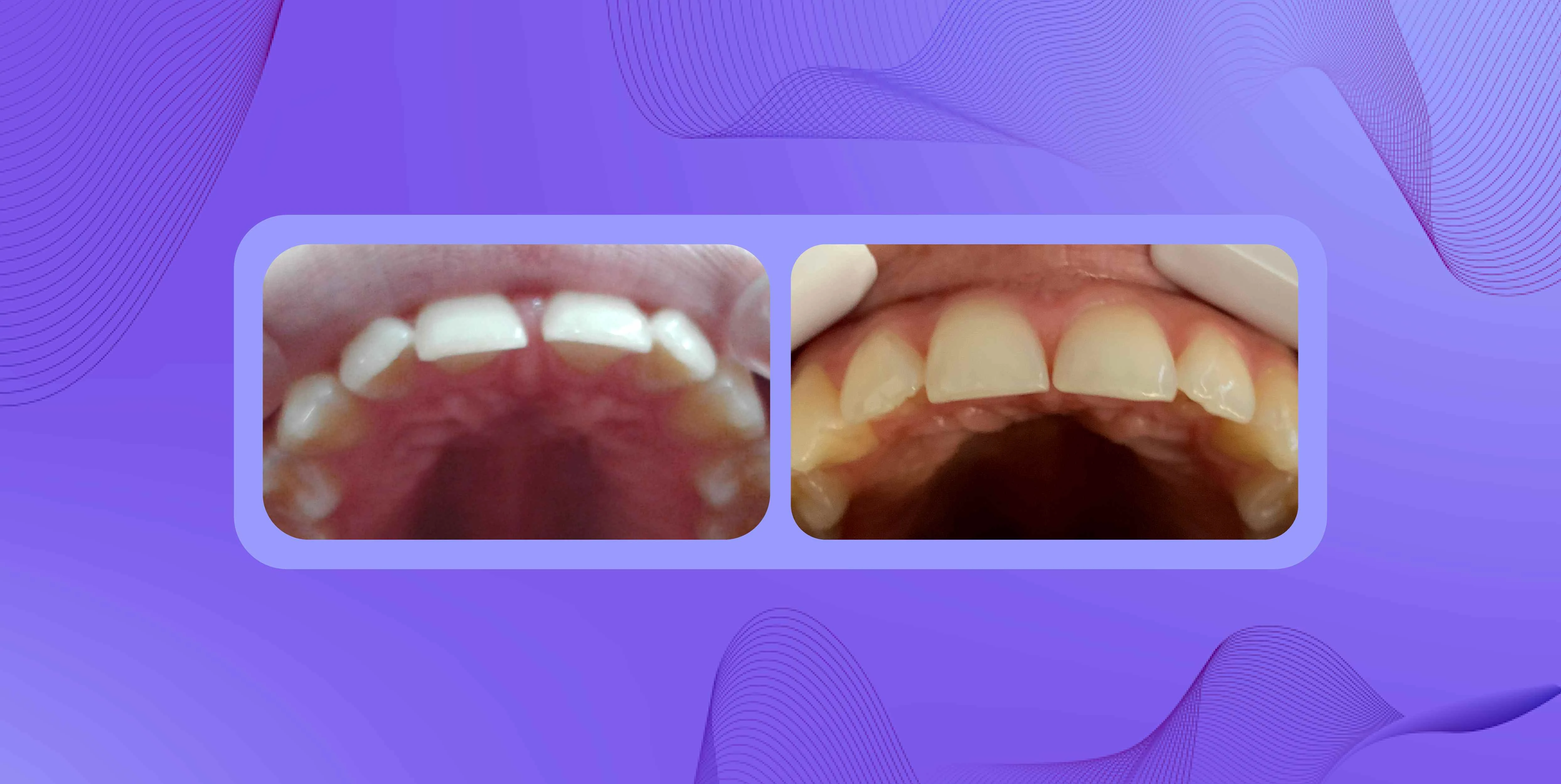 Paciente con diastema