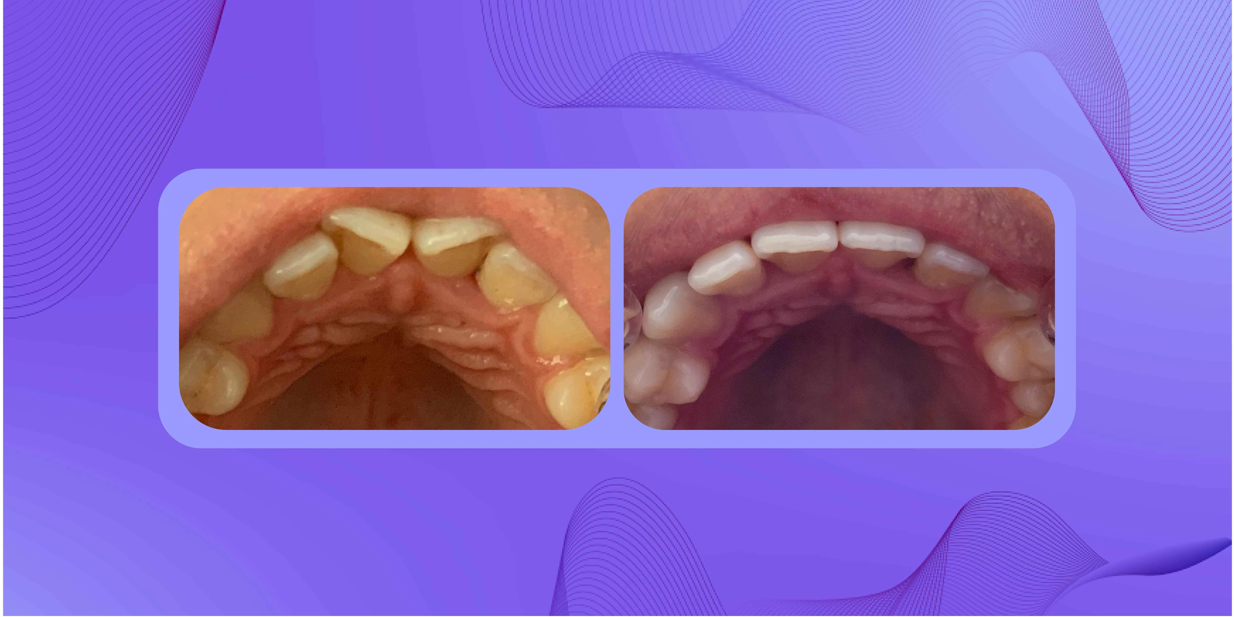 Paciente con giroversión